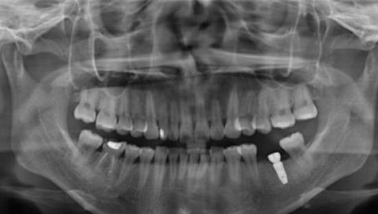 重慶牙衛士口腔崔南種植牙案例分享